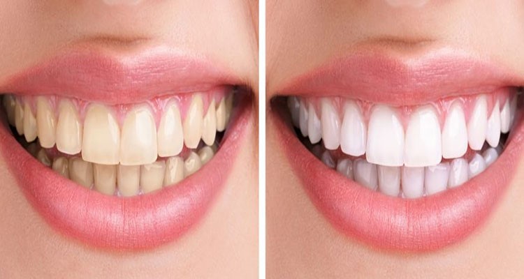 درک فرآیند بلیچینگ دندان