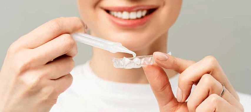 شناخت انواع روش های سفید کردن دندان
