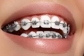 راه های درمانی دندان قروچه