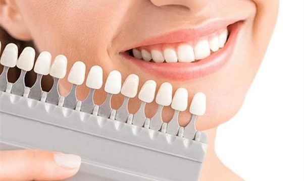 مراقبت طولانی مدت برای روکش های دائمی دندان