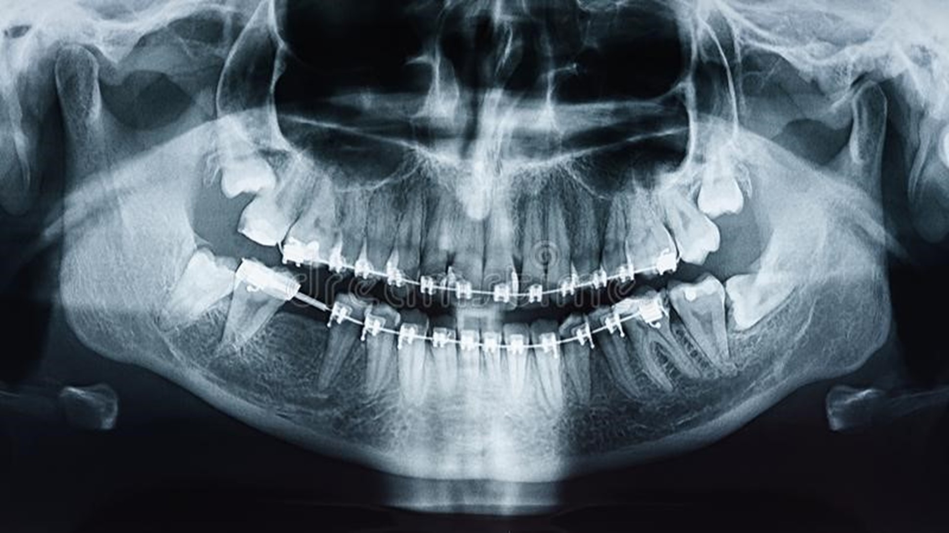 رادیوگرافی دندانپزشکی