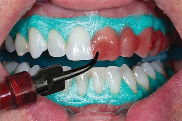 بلیچینگ دندان یا سفیدکننده دندان (Teeth whitening)