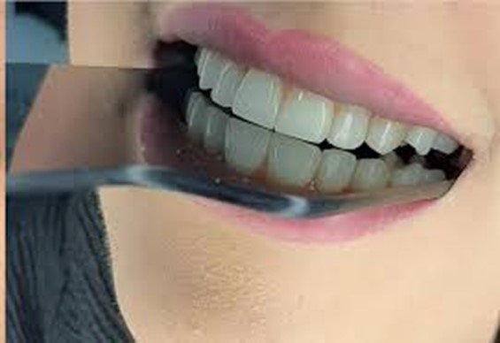 انواع روش بلیچینگ دندان
